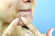 Acne pus, Close up photo of acne prone skin problem, Woman squeezing pimple with dirty bare hands, Removing whitehead acne from face and left lesion scar.