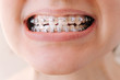 Female mouth with braces close-up, correction of malocclusion