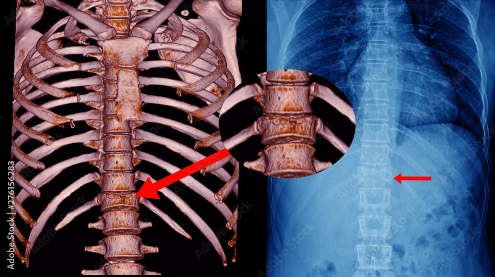 CT Scan Thoracic spine 3D and x-ray Thoracic spine finding fracture T11 ...