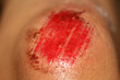 © timonina - The wound is bloody on the knee. Injury of the knee