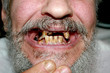 Rotten bad teeth. Beard and mustache. Caries. Periodontal disease. Dental tartar.