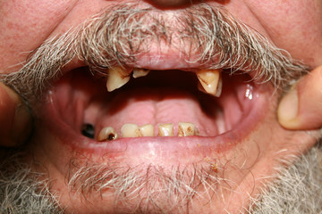 Wall Mural - Rotten bad teeth. Beard and mustache. Caries. Periodontal disease. Dental tartar.