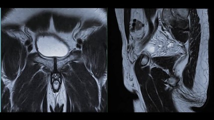 Wall Mural - MRI Lower abdomen or MRI prostate gland for diagnosis prostate cancer.