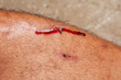 © lovelyday12 - man injured. Close-up wound on  leg.health care concept