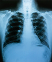 Naklejka na meble X-ray film, lung and bone structure, health examination