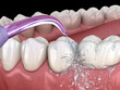 © Alex Mit - Irrigator, Water teeth cleaning. Medically accurate 3D illustration of oral hygiene.