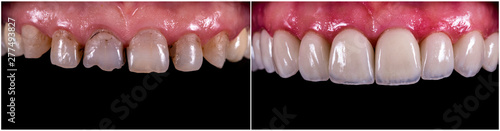14 unit zirkon based press ceramic crowns , before and after the treatment
