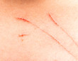 © studybos - scratches on the skin of a child