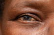 A macro view on the eye of an African grandfather. A cloudy cataract is seen in detail. Degenerative eyesight disorder commonly associated with old age.