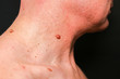 © Vadym - Big birthmark on the man's skin. Medical health photo. Papillomas on the neck.