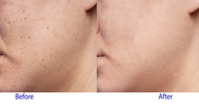 Picture Of Before And After Treatment In Beauty Clinic Of Woman's Problematic Skin , Acne Scars ,oily Skin And Pore, Dark Spots And Blackhead And Whitehead On The Face.