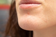 © Alessandro Grandini - An extreme close-up view on the chin of a young Caucasian lady. Inflames pus filled spots are seen with open pores and imperfections. Infected spots similar to herpes outbreak.