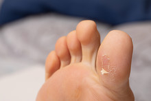 A Close-up View On The Underside Of A Human Foot. Details Of The Shedding And Dead Skin From A Large Healing Blister.