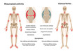 MobileThe difference between rheumatoid arthritis and osteoarthritis. On the body, arthritic sites are marked. Images of joints affected by rheumatoid arthritis and osteoarthritis. Vector illustration