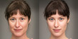 Woman before and after a rejuvenation treatment. Wrinkles, crow's feet and eye bags removal