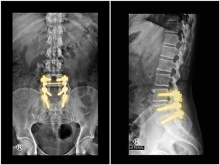 Wall Mural - Film x-ray radiograph lumbar spine showing spinal stenosis treated by decompressive laminectomy with fusion and  fixation with pedicle screw and rod . Highlight on implant. Medical technology concept.