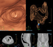 © samunella - CT colonography compare 2D Axial,sagittal ,coronal plane  and 3D rendering image for screening colorectal cancer. Check up Screening Colon Cancer.