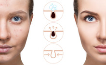 Graphically Shows How To Pollute And Clean The Pores On Face.