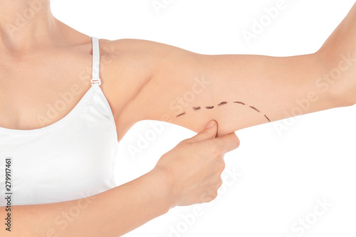 Fotomural Woman with marks on arm for cosmetic surgery operation against white background,