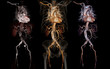 Comparison of CTA abdominal aorta 3D rendering image with stent graft on transparent skeletal .