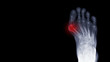 © Joel bubble ben - Film x-ray foot radiograph show Hallux valgus deformity or Bunion disease with free copy space and dark background. The patient has toe pain symptom. This cause shoe wearing and cosmetic problem.