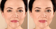Beautiful mature woman before and after biorevitalization procedure on beige background, closeup
