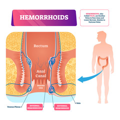 Sticker - Hemorrhoids vector illustration. Labeled anatomical vascular piles scheme.