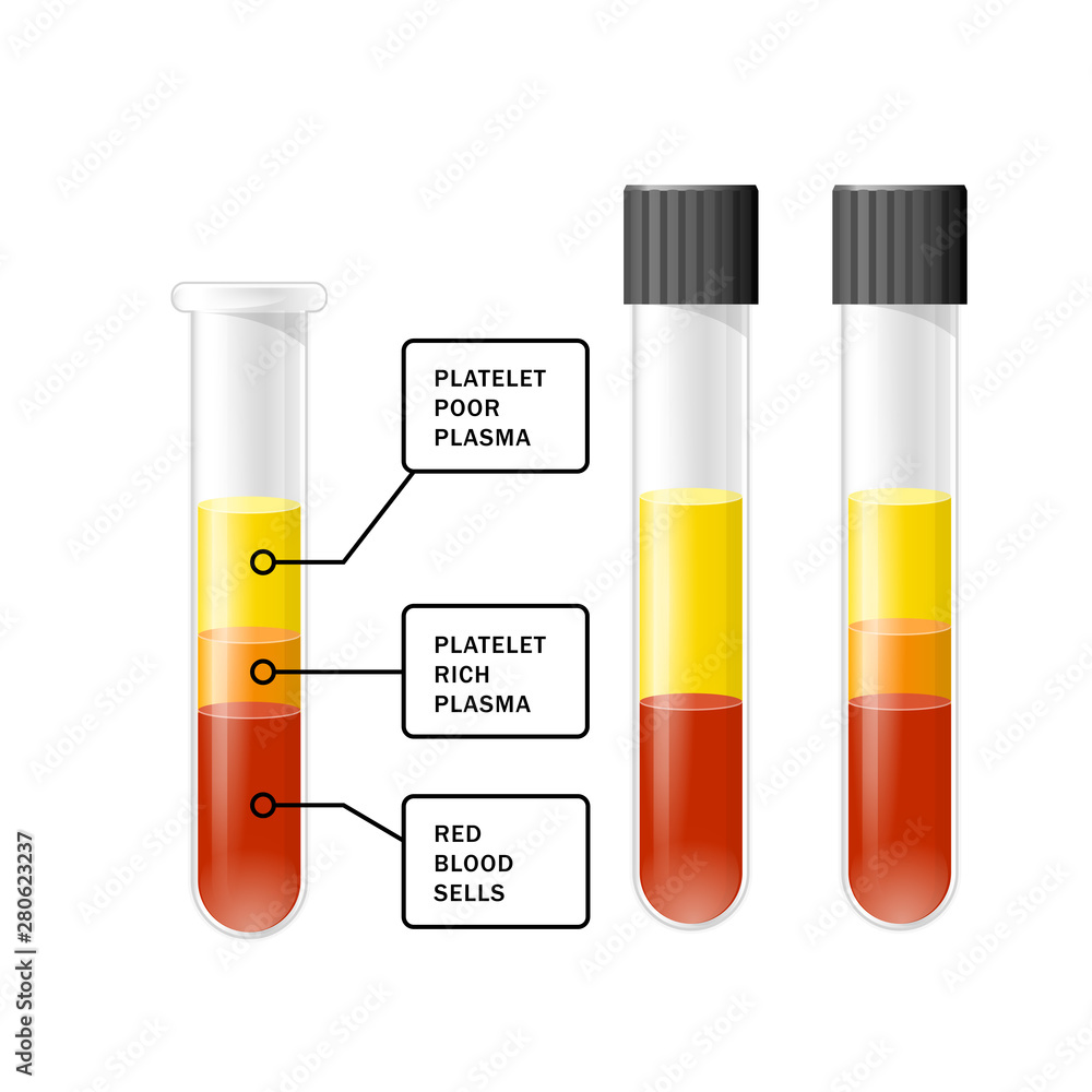 Blood after separation of platelets in the centrifuge in test tube, PRP  infographics, platelet-rich plasma Stock Vector | Adobe Stock, image size:1000x1000