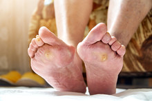 An Elderly Woman Feet With Podagra, Fungus And Diabetic Ucler, Callus. Healthcare Concept
