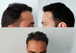 Receding hairline in men. hair loss