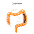 Constipation. human large intestine with fecal matter