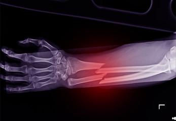 X-ray forearm fracture shaft of radius and ulnar bone