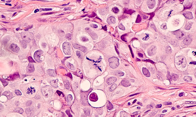 Wall Mural - Photomicrograph of a breast cancer (grade 3 invasive ductal carcinoma) with frequent mitoses (mitotic figures), including a large central atypical mitosis.