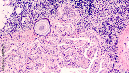 Metastatic papillary thyroid carcinoma (cancer) involving a lymph node ...