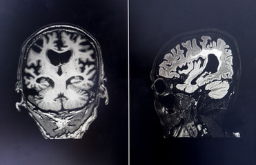 Wall Mural - brain MRI for education Dementia Mix type stroke VaD