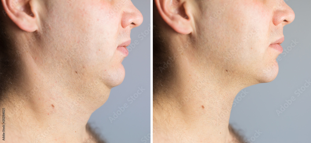 Man before and after double chin fat correction procedure - obrazy, fototapety, plakaty 