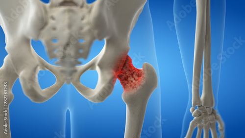 Cuadros en Lienzo 3d rendered medically accurate illustration of an arthritic hip joint