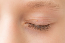 Close Up Of Wart On Eyelid. Young Girl With Papillomas On Skin Around Eye, Macro