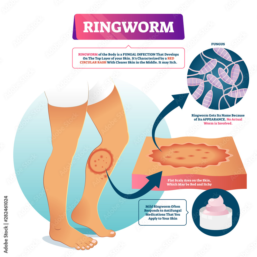 Buni Image Ringworm vector illustration. Labeled fungal skin infection example ...