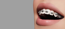 Beautiful White Teeth With Braces. Dental Care Photo. Woman Smile With Ortodontic Accessories. Orthodontics Treatment