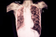 severe tuberculosis