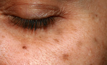 Brown Spots On The Face. Pigmentation On The Skin. Brown Age Spots On The Cheek.