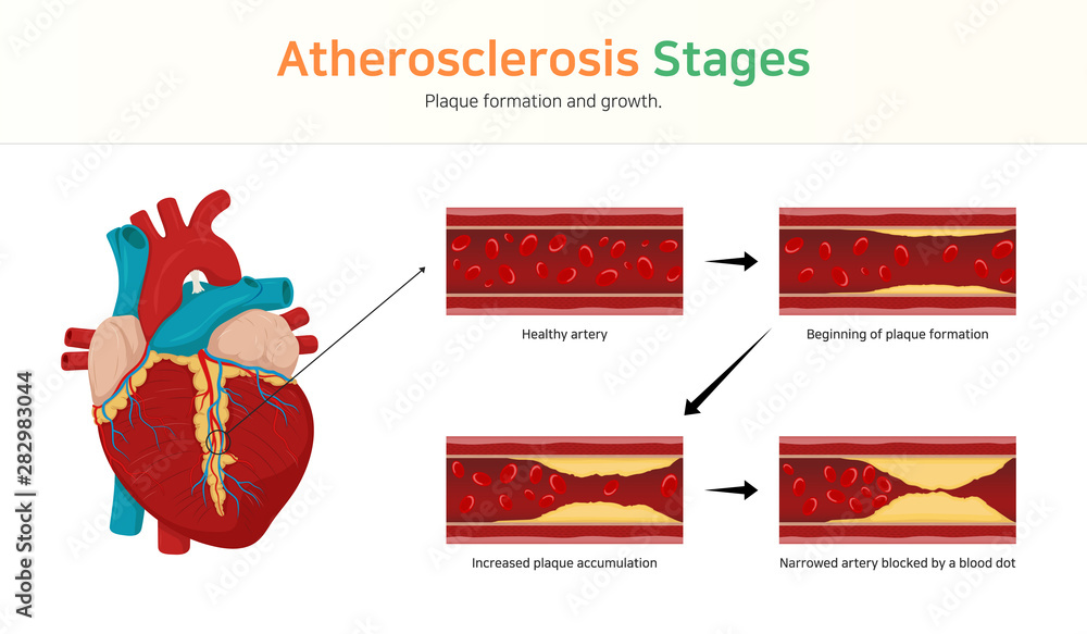Atherosclerosis stages. Plaque formation and growth. - obrazy, fototapety, plakaty 