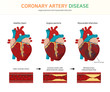 coronary artery disease. (angina pectoris and myocardial infarction)