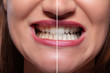 © Andrey Popov - Person Teeth Before And After Whitening
