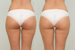 © LanaMais - Female buttocks before and after treatment comparison