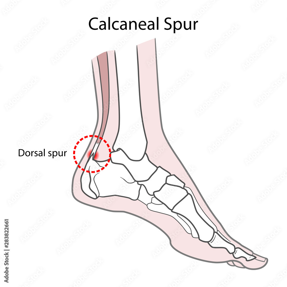 Dorsal spur (calcaneal spur). Human foot bones. Vector illustration ...