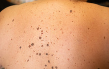 Woman Patient On Clinical Trials With Lot On Brown Nevus On Body Back