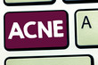 © Artur - Text sign showing Acne. Conceptual photo Skin disease involving the oil glands at the base of hair follicles.
