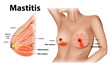 Mastitis is inflammation of the breast